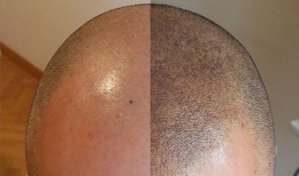 hair micropigmentation Budapest